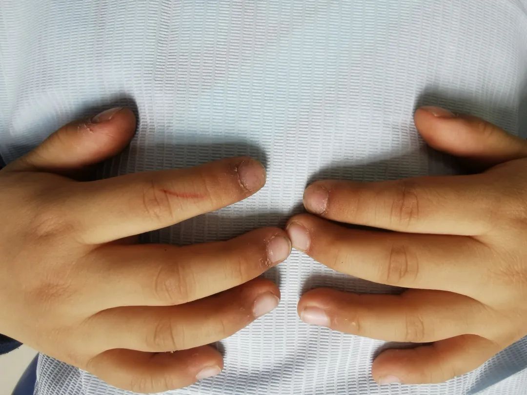 孩子口腔问题家长一定要重视,宝宝吃手口腔疾病