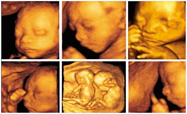 孕期最多能做几次b超,孕期需要做几次b超检查