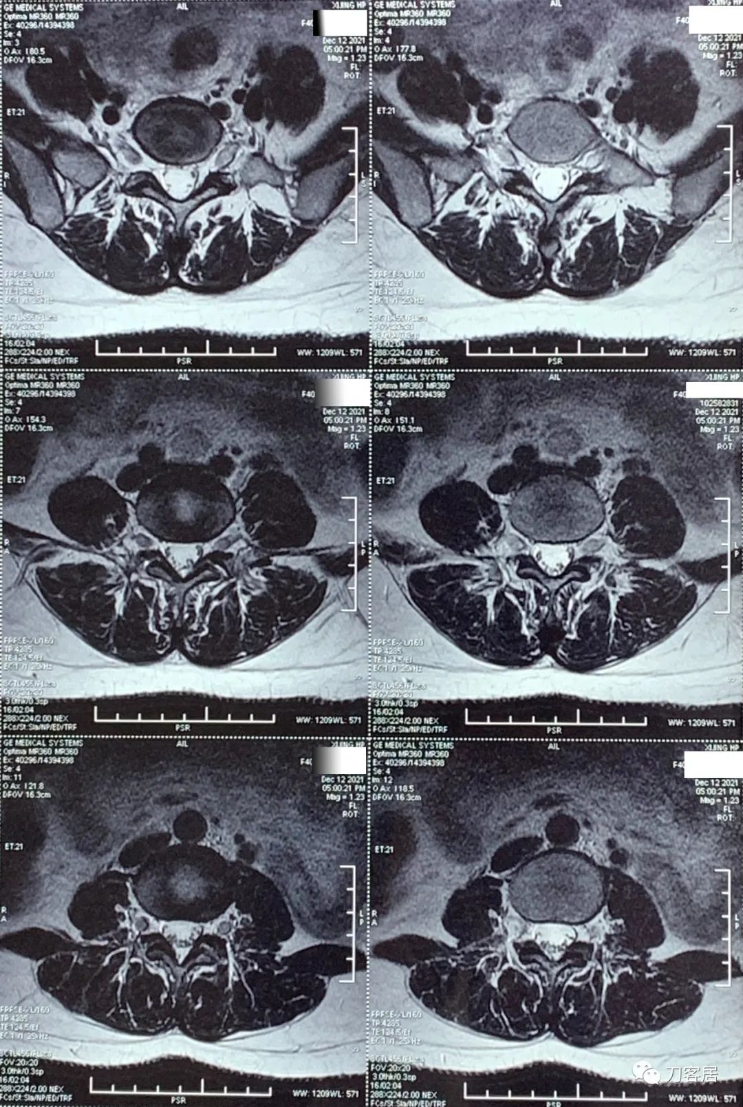 50多岁女性剧烈腰痛,40岁女人腰痛是什么原因引起的