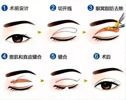 想割双眼皮怕失败,割双眼皮踩雷了应该找医院吗