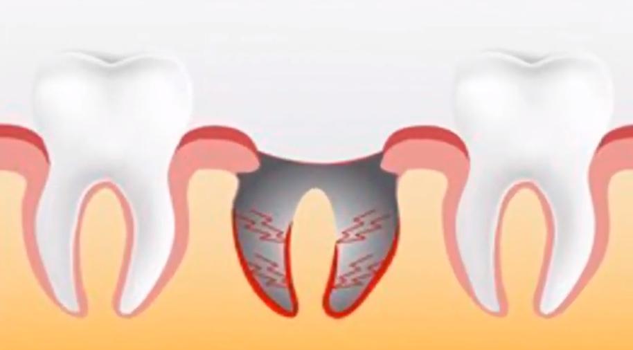 拔牙后一阵一阵的疼是干槽症吗,干槽拔牙要当心3个并发症