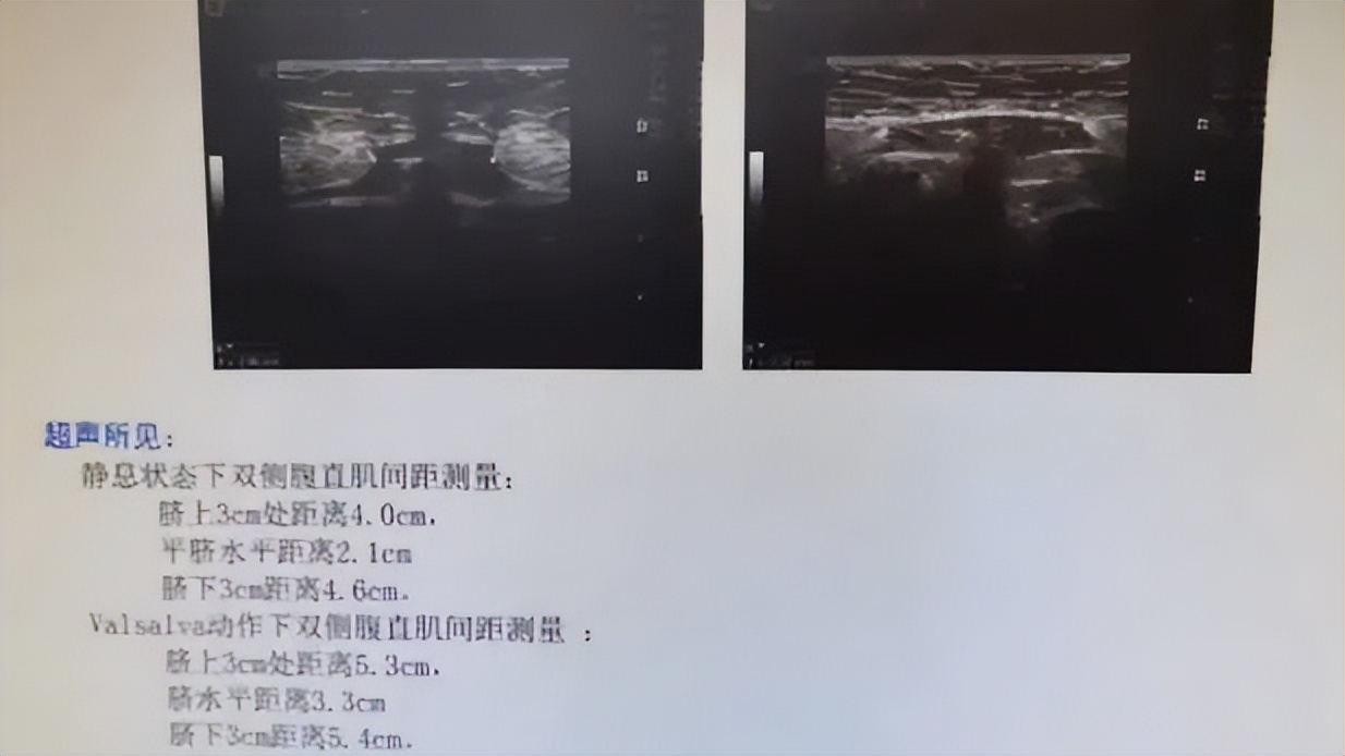 产后三个月能练刘畊宏吗,剖腹产多久可以练刘畊宏减肥操