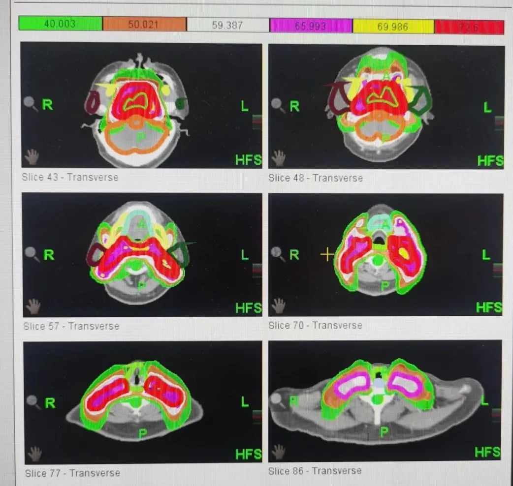 鼻咽癌是怎样放疗的,有什么方法治愈鼻咽癌的