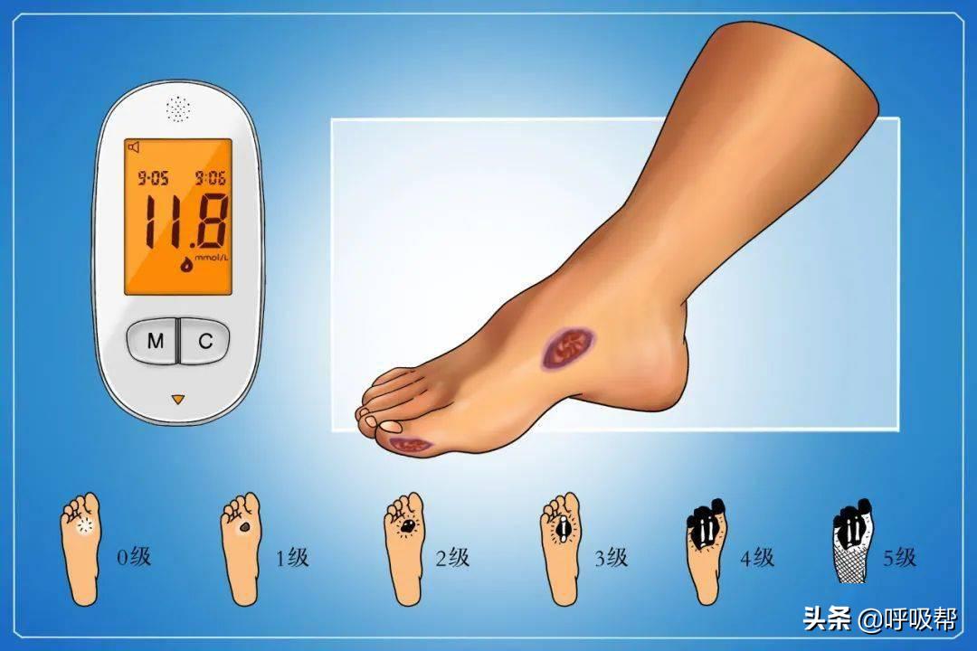 糖尿病早期症状和自查方法,糖尿病的早期的15大症状