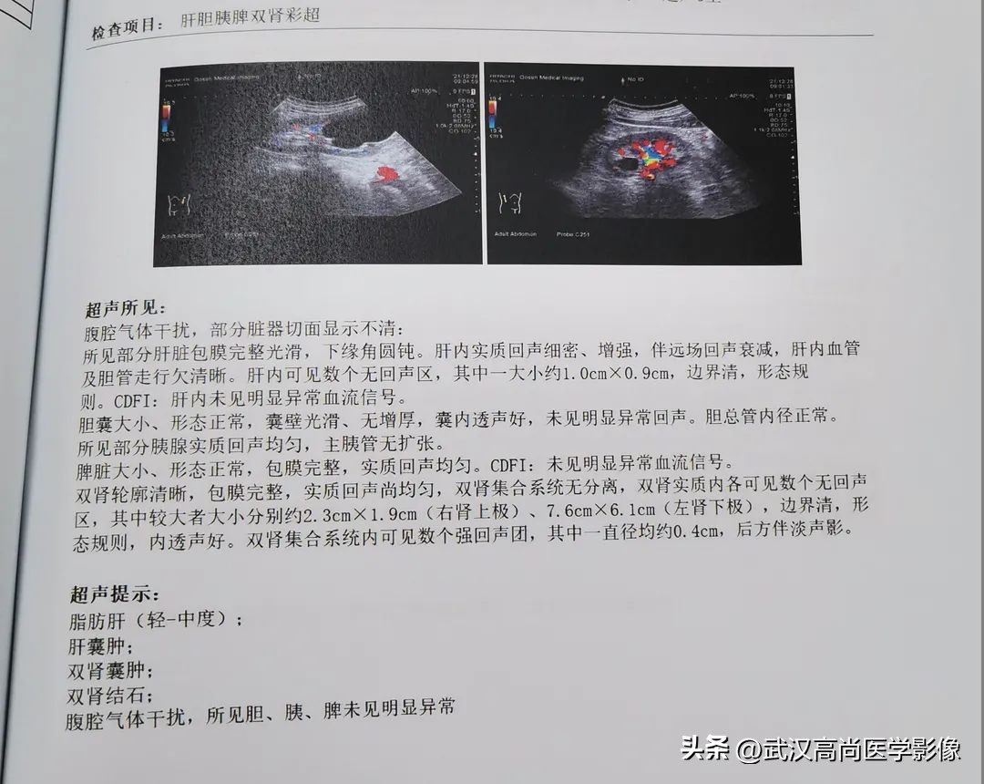 囊肿哪些检查后确认癌症,囊肿检测肿瘤指标很高