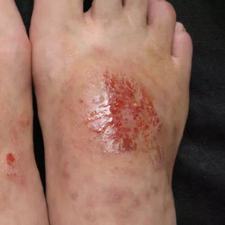 脚底疼是猝死的前兆吗,脚底脱皮是癌症的前兆