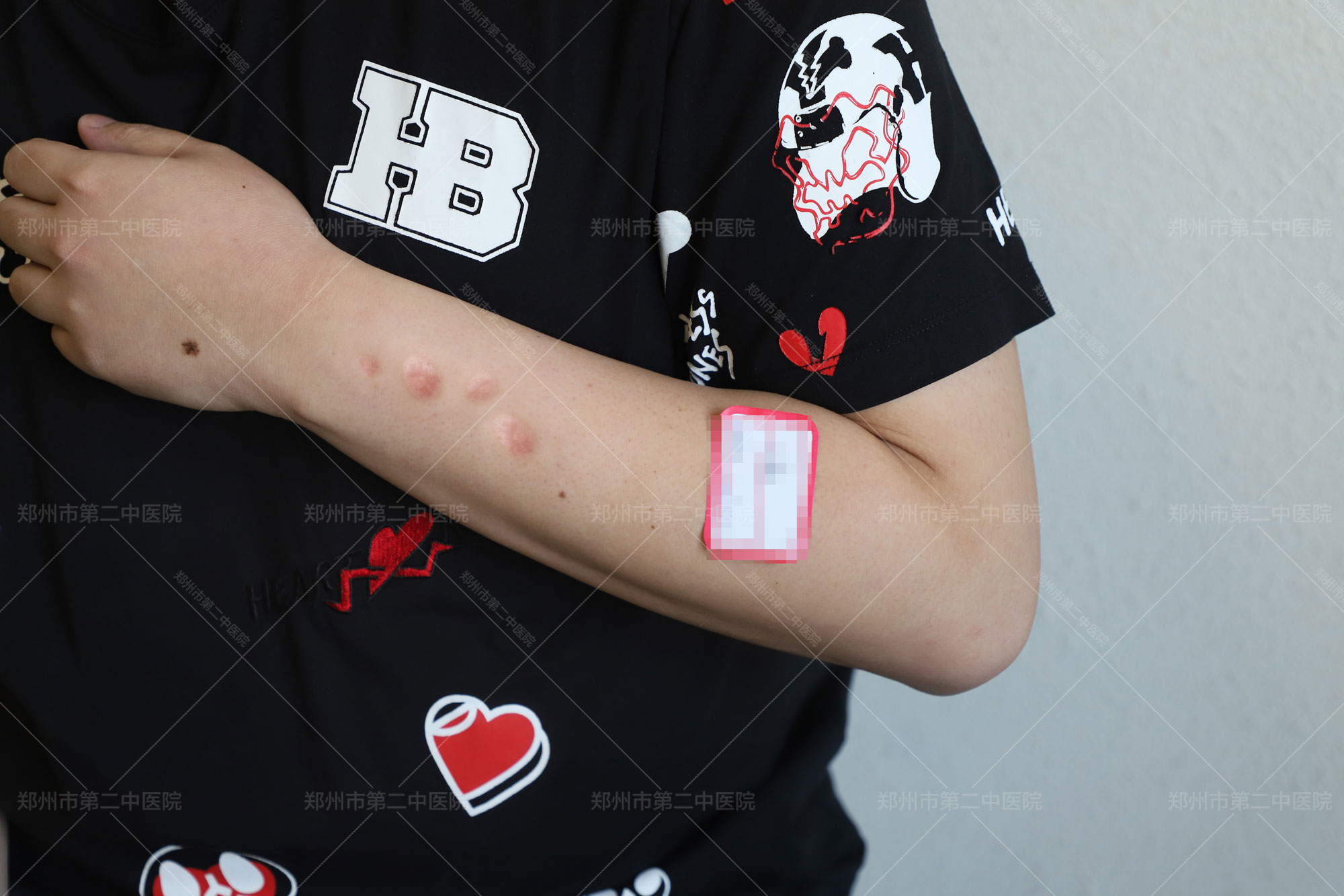 郑州祛疤好医院？手臂烟疤该怎么治疗？