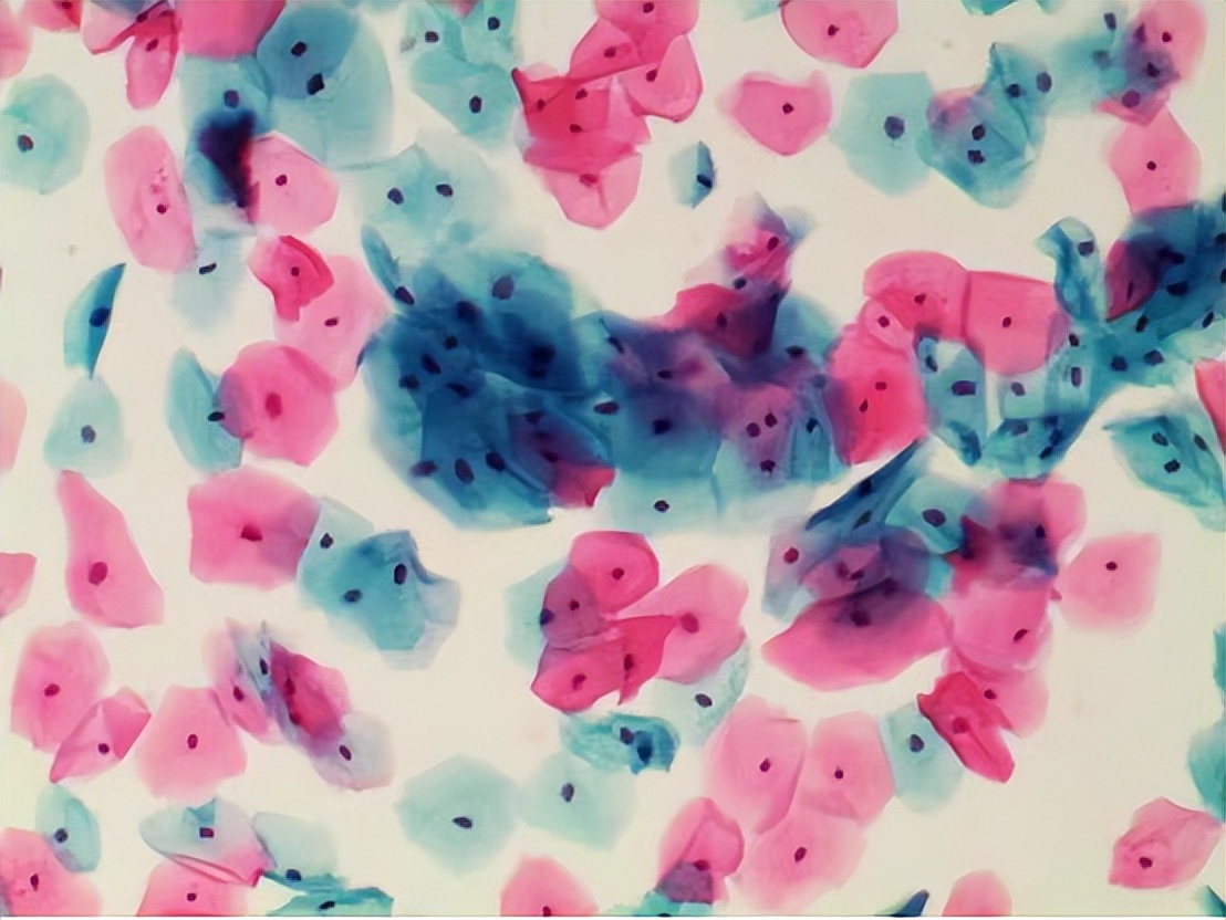 科普|妇科检查的TCT和HPV有什么区别？