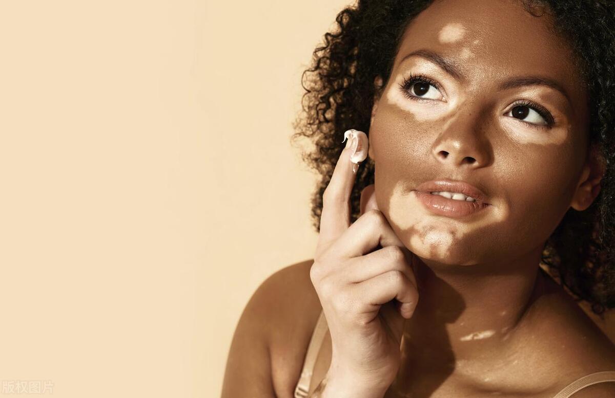 要想白癜风早日康复，这些关键点你做到了吗？