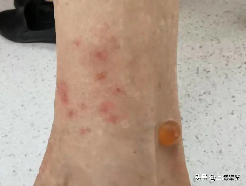 夏季被虫子咬了怎么办,夏季皮肤病攻略虫咬感染篇