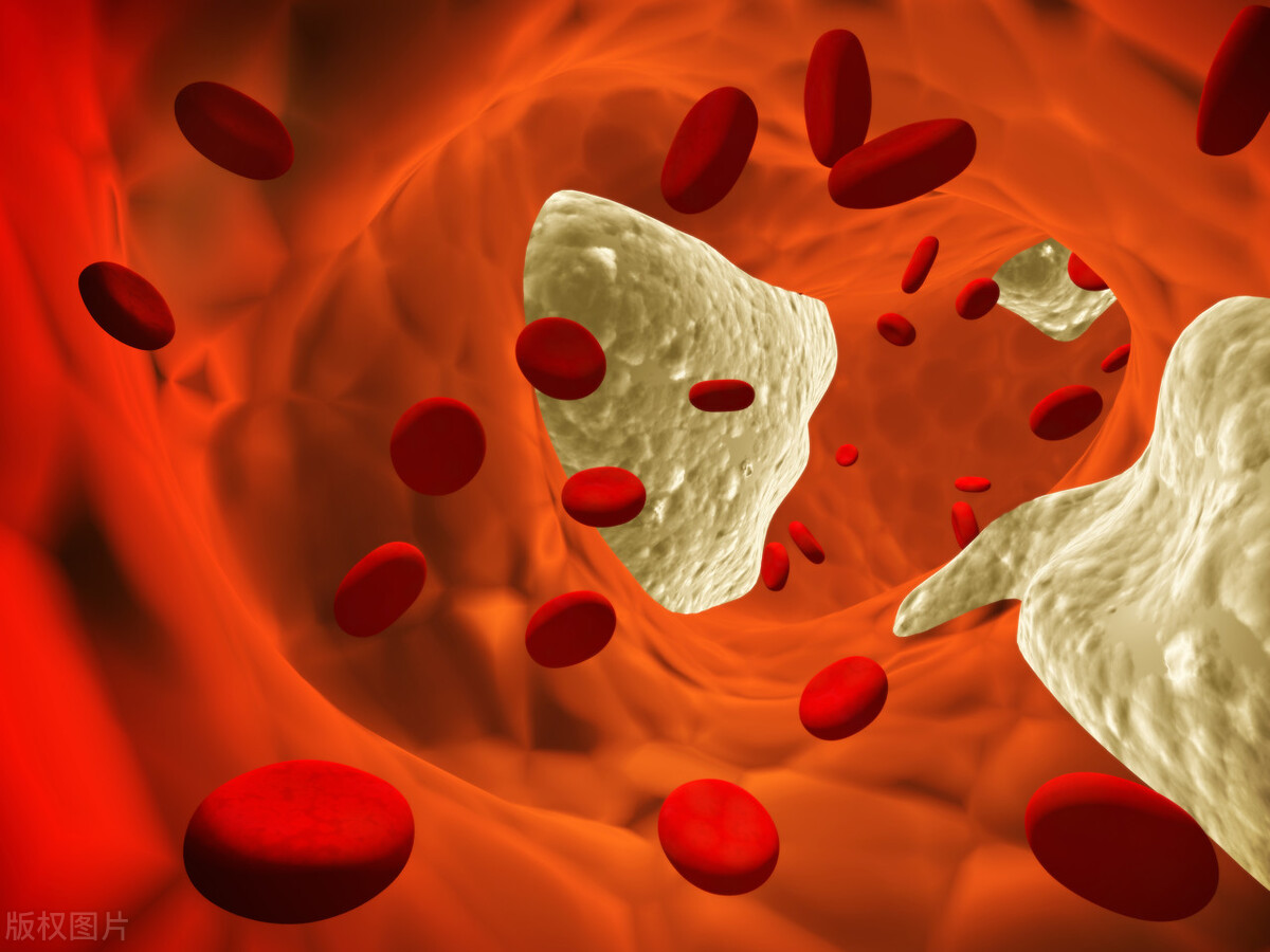 血粘稠度增高容易血栓吗,化验血什么高容易血栓