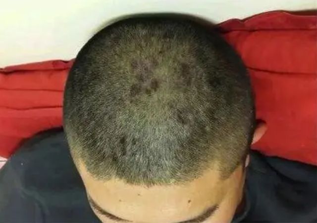 头皮上长红疙瘩脓包是什么原因,头皮经常起小脓包疙瘩很疼