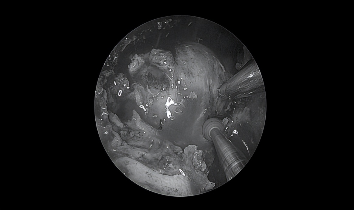 南昌二附院耳鼻喉科手术,南昌大学第二附属医院耳鼻咽喉科