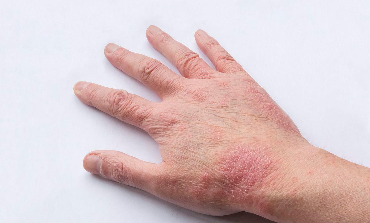 便宜好用的四妙丸，不仅清热利湿，还可适用于这5种病