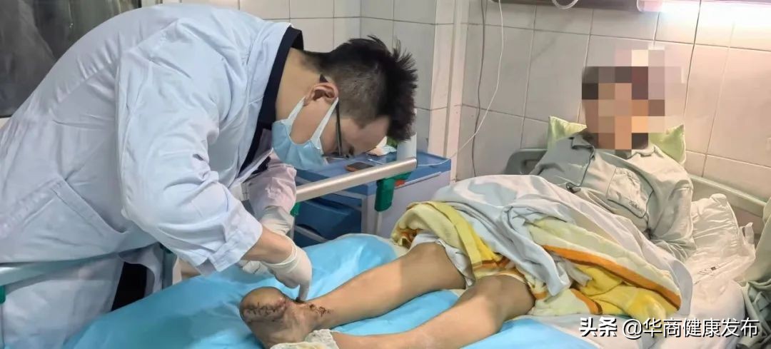 -30°低温冻伤双脚三次手术为其保留“残足长度”