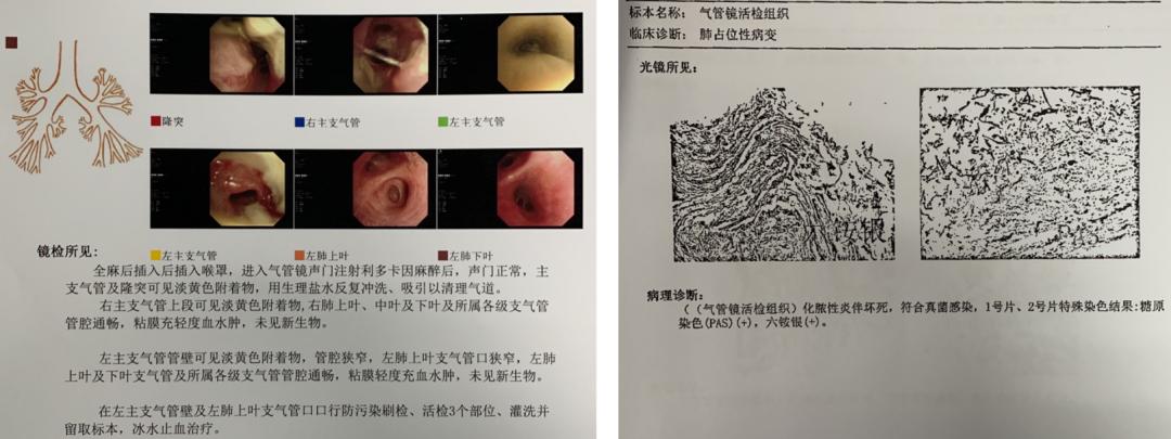 男23岁因上呼吸道感染剧烈咳嗽,34岁小伙咳嗽一个星期了