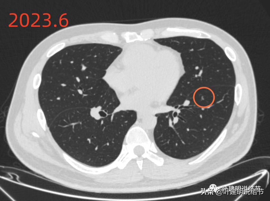 肺炎好了磨玻璃结节还存在,球形肺炎治愈后肺部留有结节