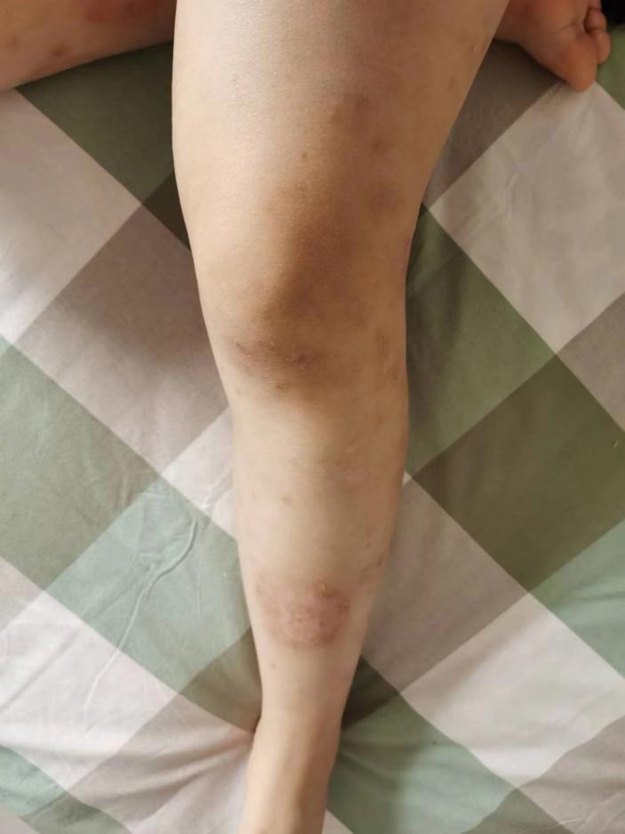 【门诊医讯】河北省人民医院皮肤科专病门诊——银屑病门诊