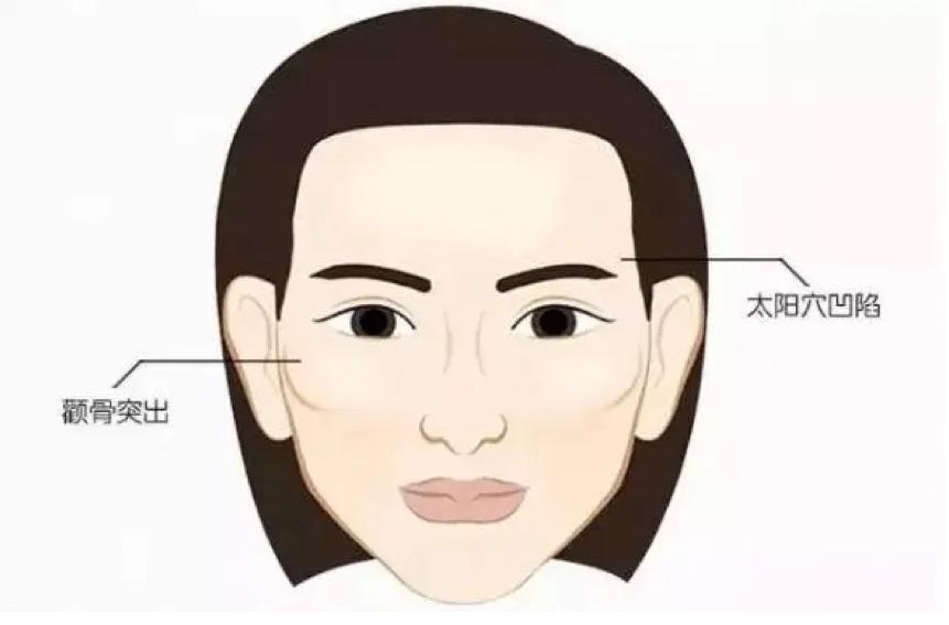 九院韦敏改脸型,九院填充太阳穴失败案例