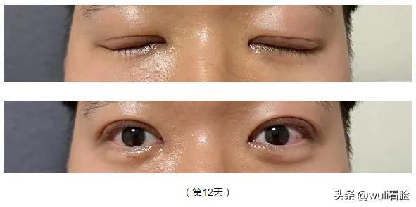 男生割双眼皮的意思,男生眼睛小割双眼皮会好看吗