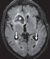 脑水肿的影像,脑水肿形成机制生理学