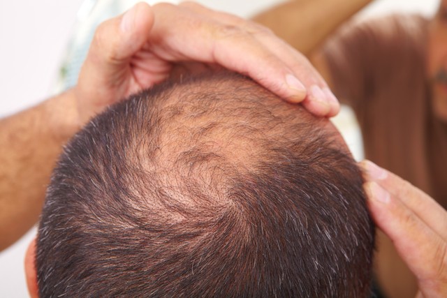 中医治疗脱发枯黄细软,脱发补气血食疗方法