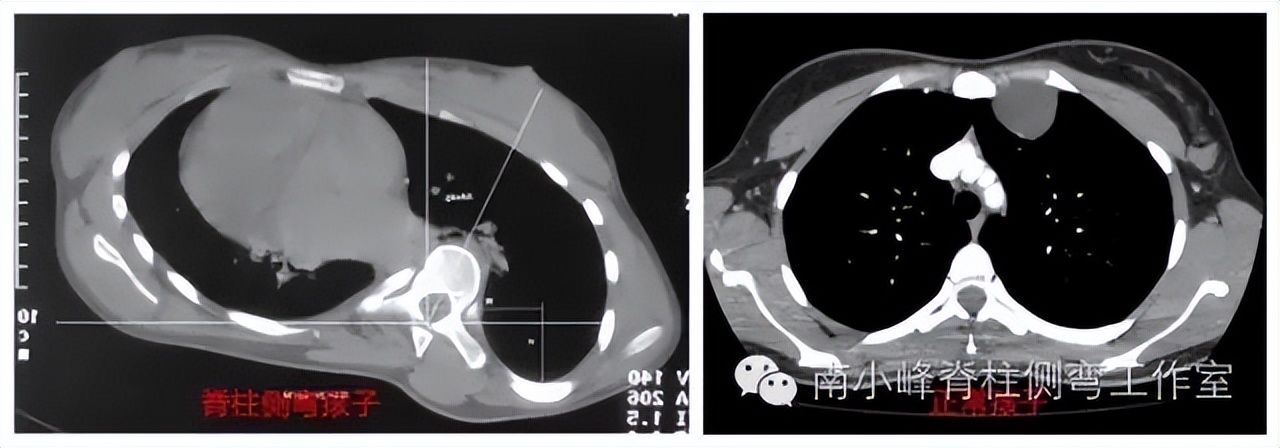 脊柱侧弯多少度会形成剃刀背,脊柱侧弯多少度会出现剃刀背