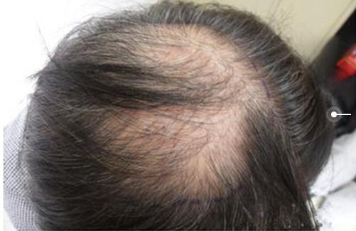 血虚脱发，血热脱发，血瘀脱发，养血凉血化瘀，三招拯救脱发危机