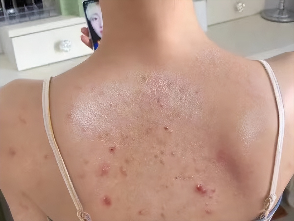 后背痘痘反反复复怎么彻底去除,后背长痘痘的清洁护理