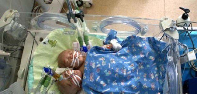 中国首例双头婴儿现状如何,全国首例双头婴儿现在咋样了