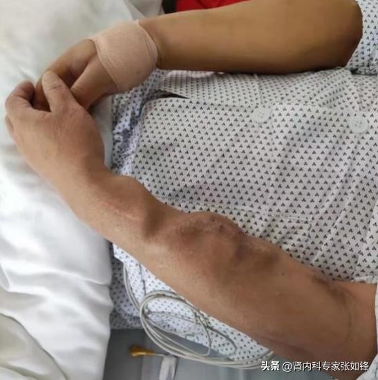 透析患者内瘘堵塞视频,临时管堵塞内瘘又没成熟怎么透析