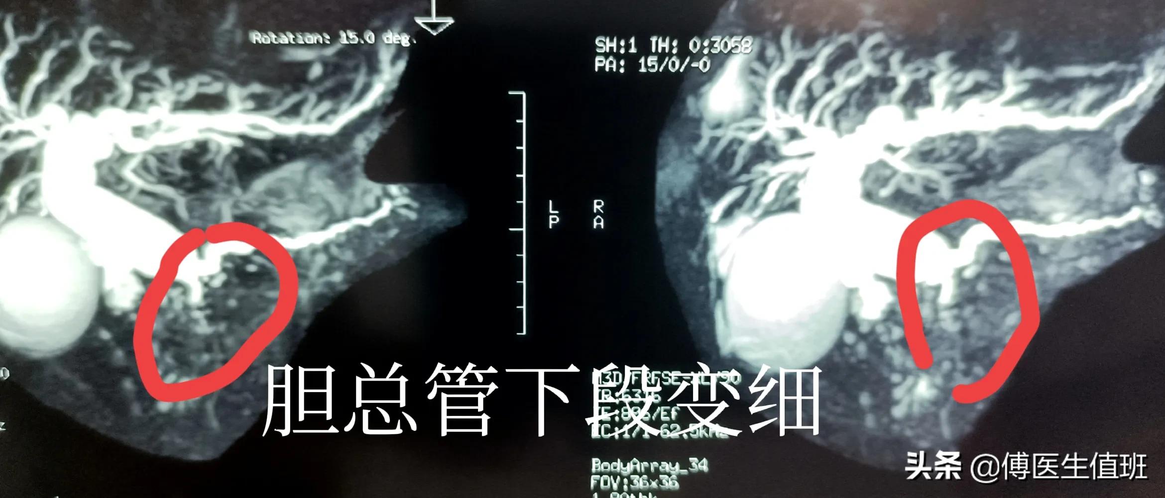男子吃鸡后腹胀、腹泻，医院检查发现转氨酶升高，医生：胰腺肿瘤