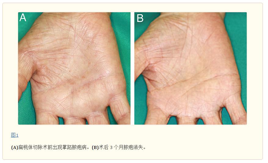 急性扁桃体切除手术的适应症,sapho综合征扁桃体切除