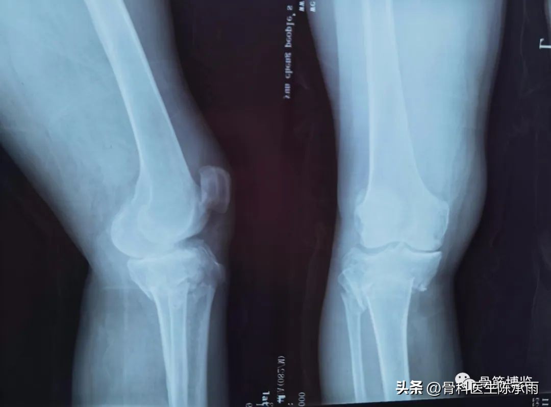 膝关节胫骨平台骨折,最近胫骨平台骨折视频
