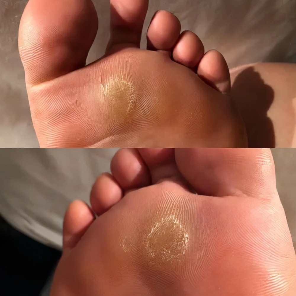 脚底板爱出脚汗怎么回事,脚底板爱紫是什么原因