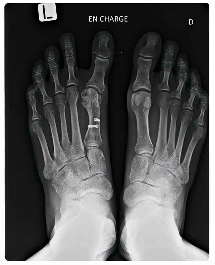 拇外翻术后——拇内翻治疗