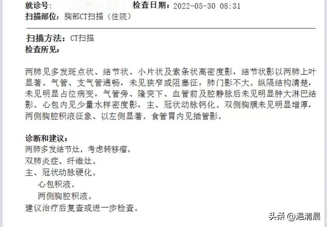 针对恶性腹水，腹腔灌注化疗显奇效