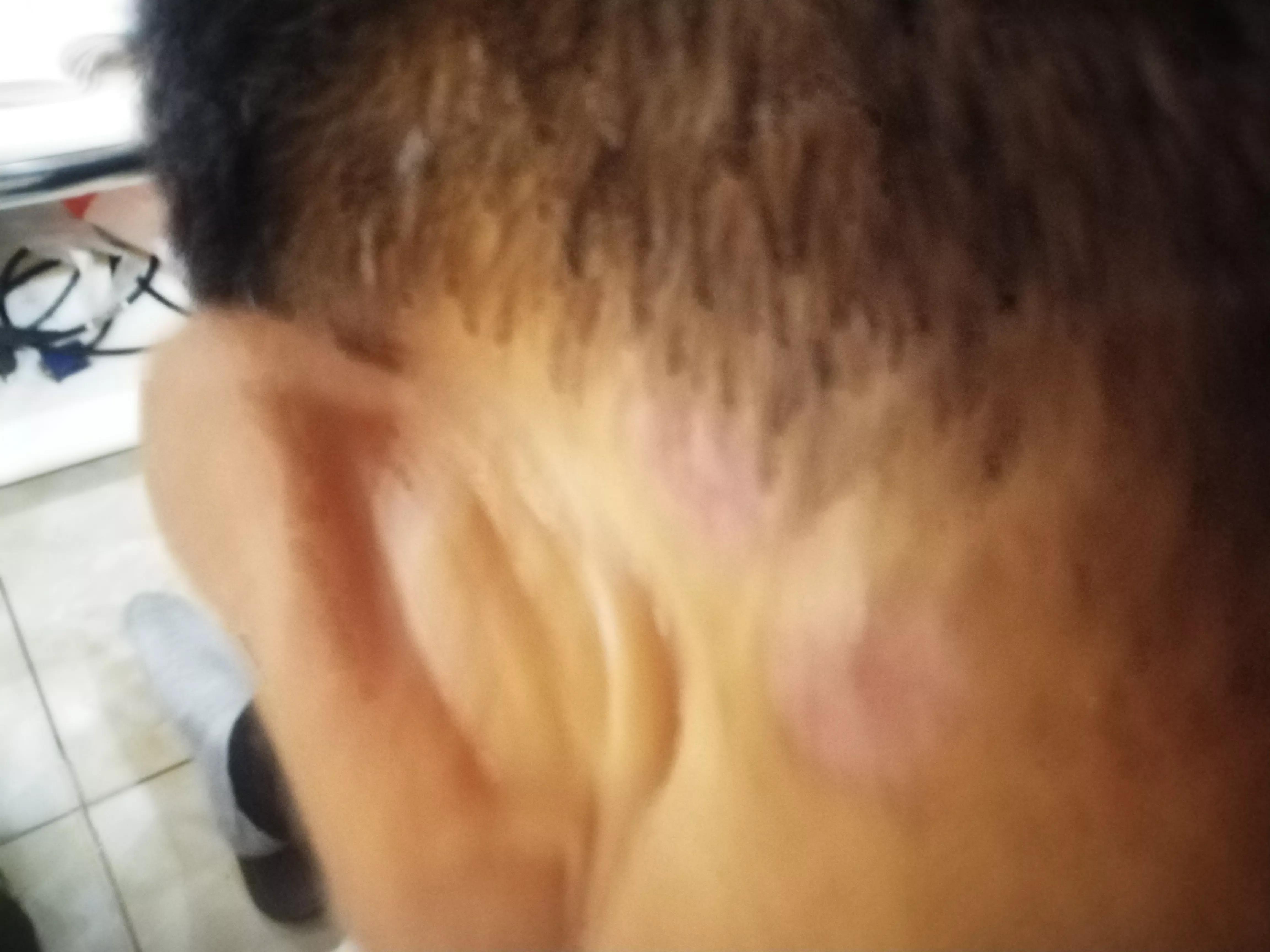 牛皮癣伴随一生是怎么样的体验,对抗牛皮癣一直在坚持