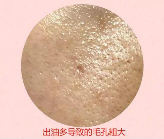 毛孔粗大收缩毛孔最有效的方法,怎么收缩毛孔解决毛孔粗大小妙招
