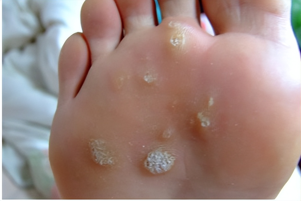 手上、脸上的“肉疙瘩”哪些是HPV导致的？6种常见疣的区分和治疗