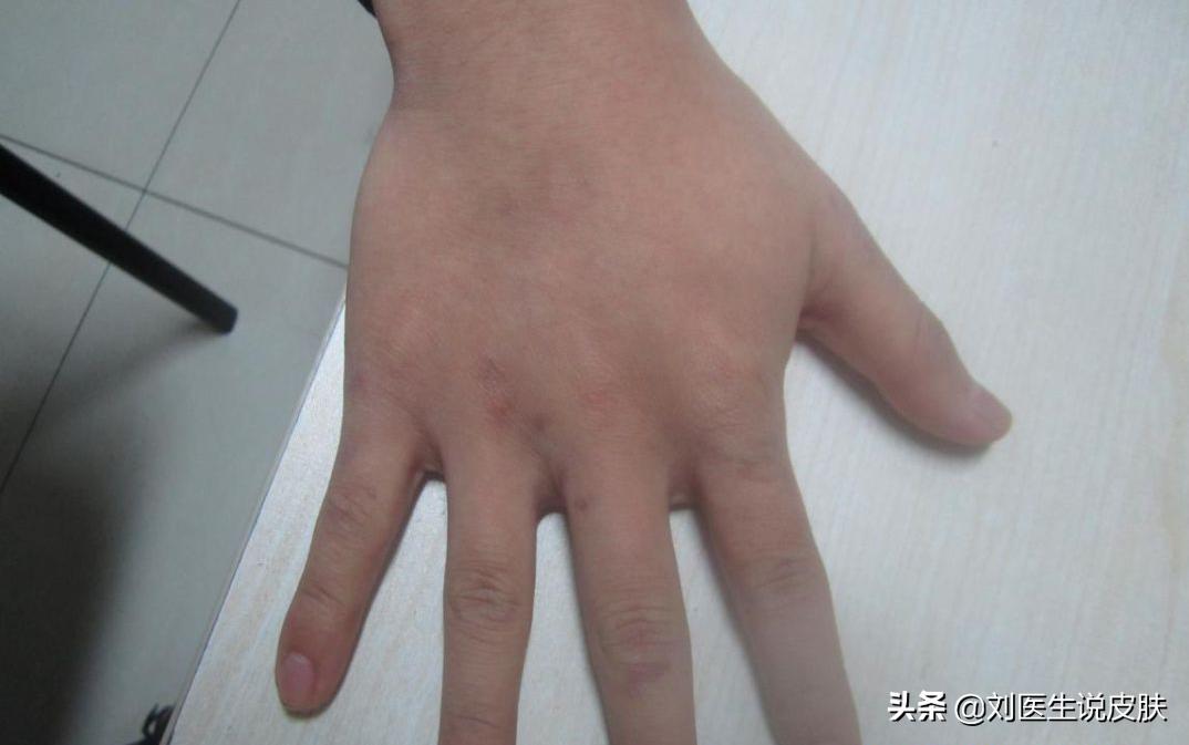 手部的白癜风怎样能治好,手部白癜风怎么治疗最好