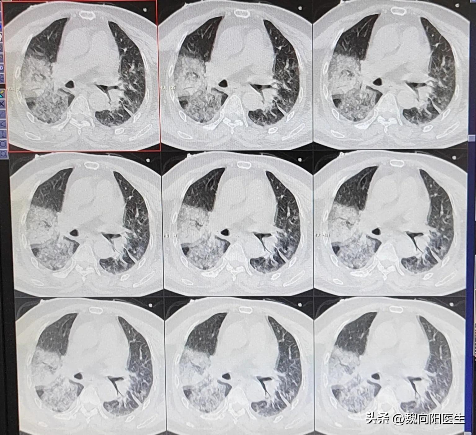 我的老父亲中风病危,我的父亲得了脑梗十九年