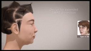 拉皮手术和面部提升术有什么区别,小拉皮和额头提升术的区别