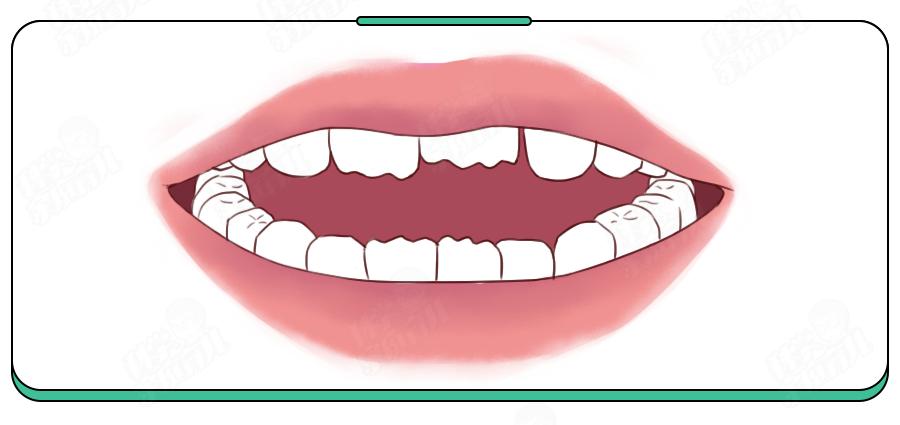 大牙基本都龋齿了怎么补救,新换的牙产生了龋齿怎么办