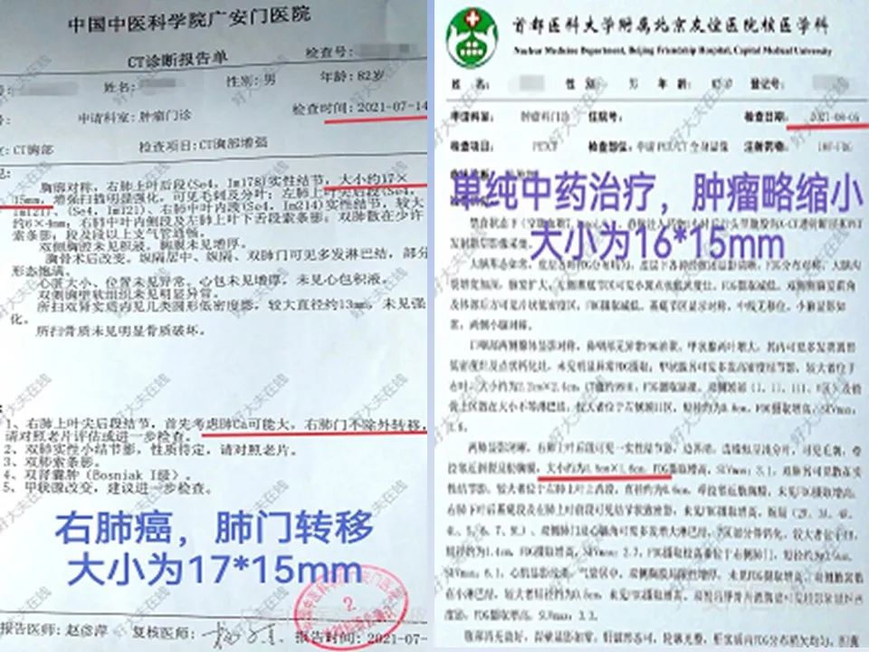 正确使用中医药治疗肿瘤才显效,关于中医中药在肿瘤治疗中的见解