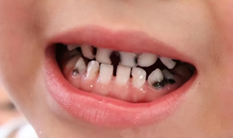 宝宝牙缝有点大这是好还是坏呢,为什么宝宝的牙缝很大