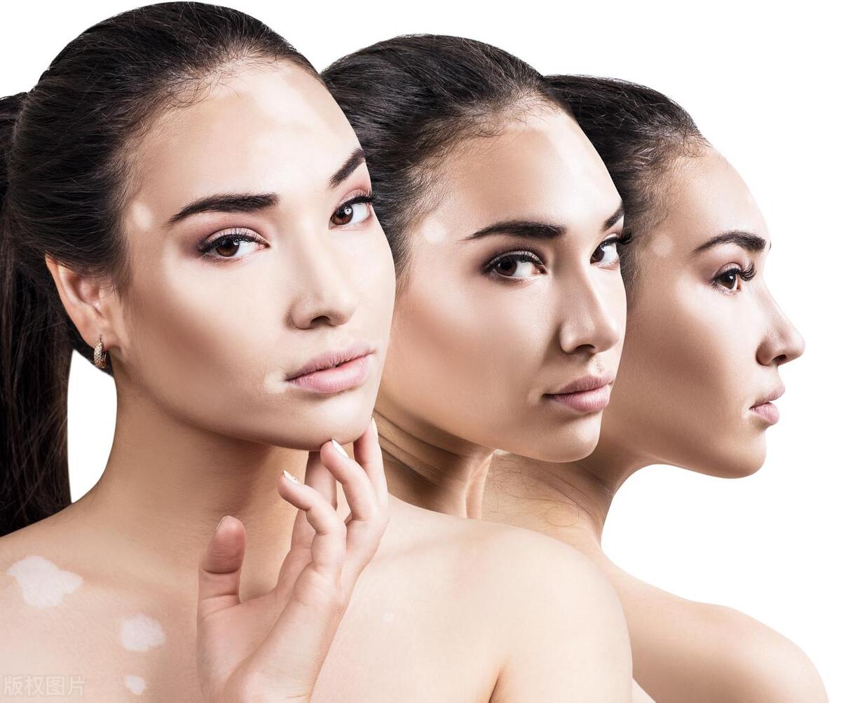 女性白癜风20岁的图片,女性白癜风是什么原因引起的