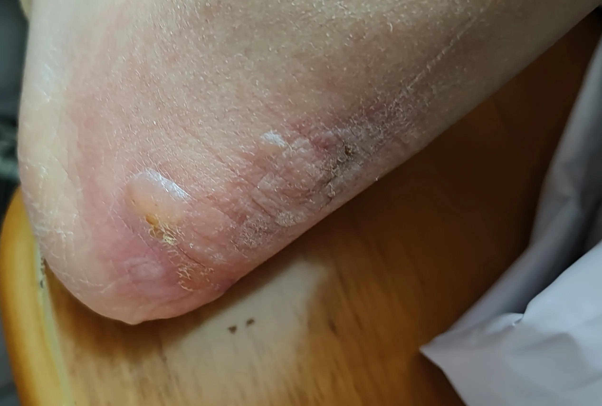 脚后跟红肿皮干,脚后跟红肿用什么药治疗