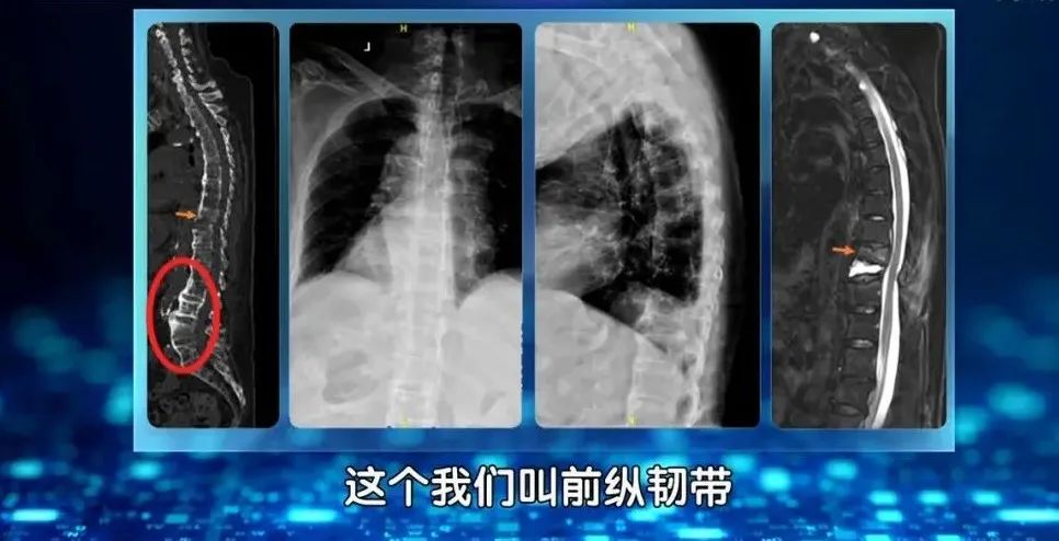 45岁男子摔倒致残后续,44岁男子摔倒