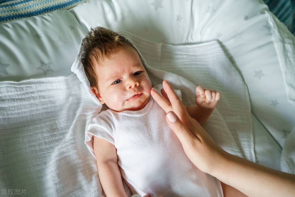 2岁宝宝长湿疹饮食上注意什么,过敏性皮炎湿疹饮食上要注意什么